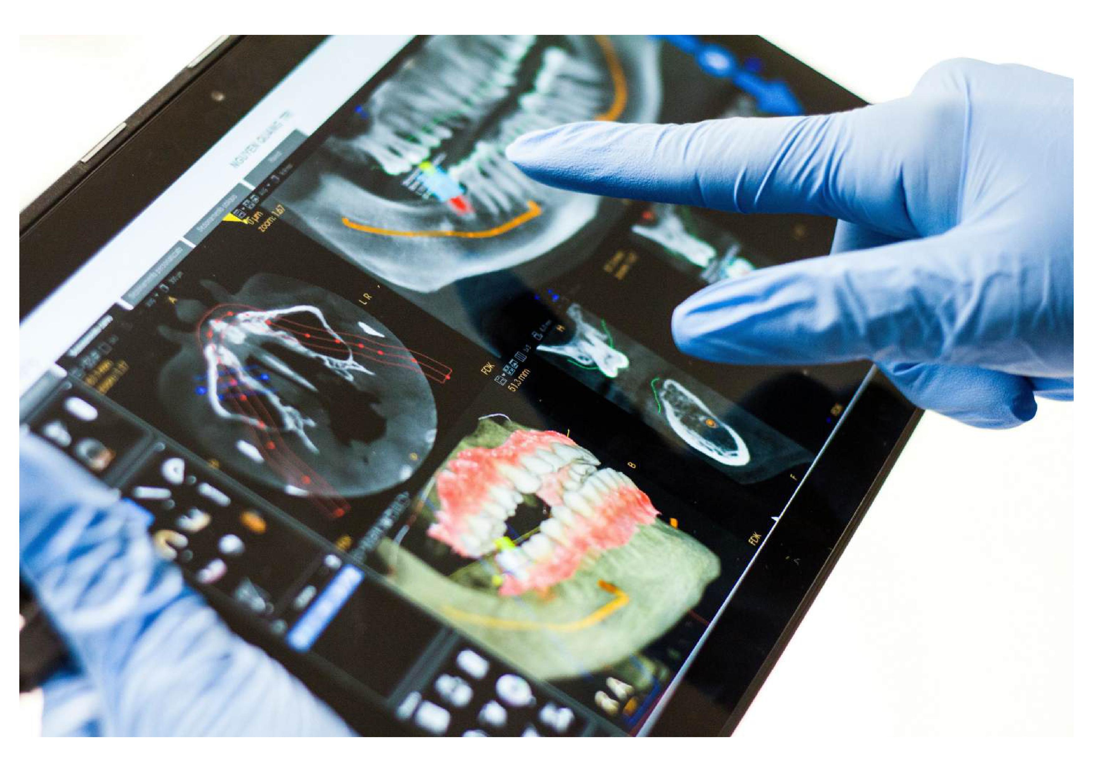 Implants dentaires avec chirurgie guidée : des solutions rapides et efficaces pour nos patients