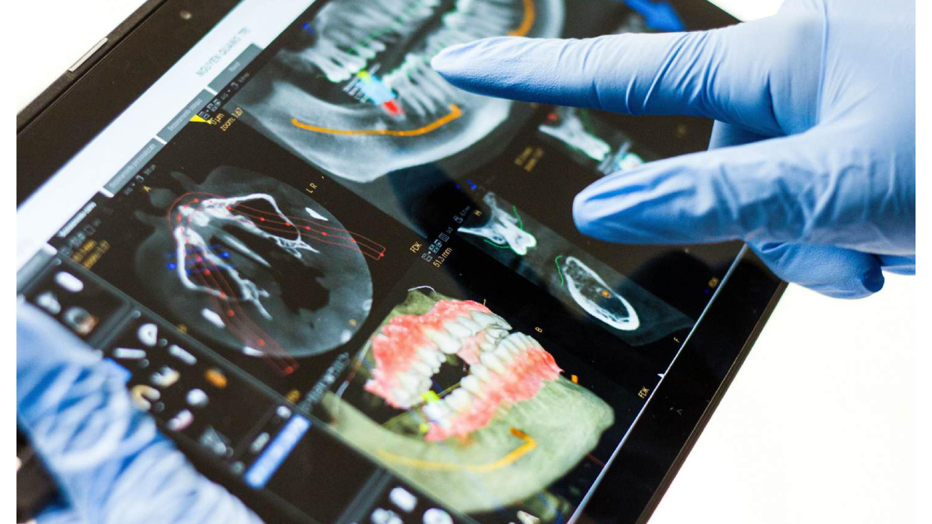 Dr. Aymen Arad - Implants dentaires avec chirurgie guidée : des solutions rapides et efficaces pour nos patients