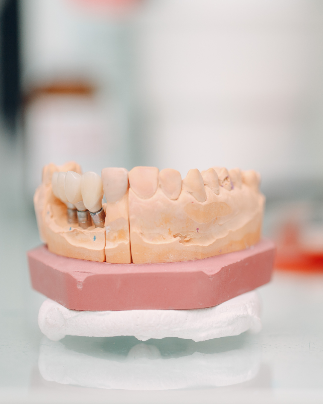 Implant dentar sau proteză? Ce alegi?