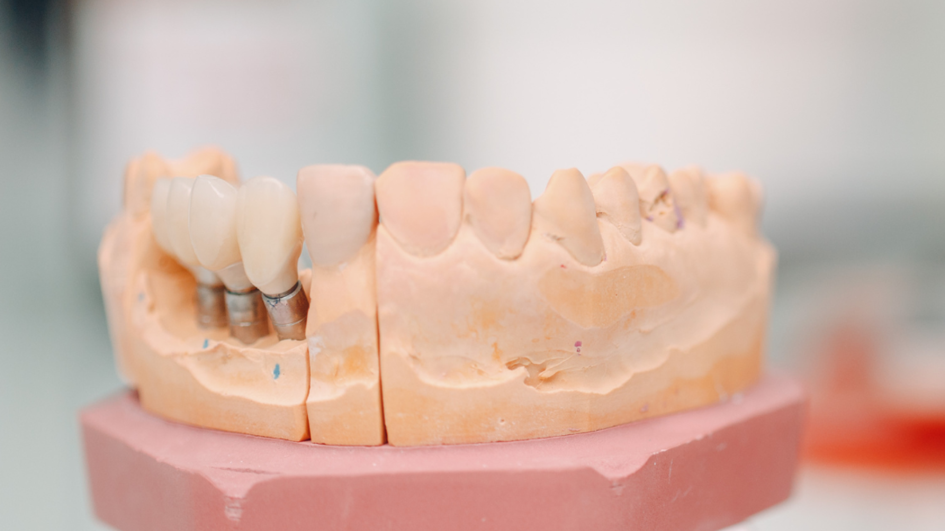 Dr. Aymen Arad - Implant dentar sau proteză? Ce alegi?