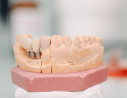 Dr. Aymen Arad - Implant dentar sau proteză? Ce alegi?