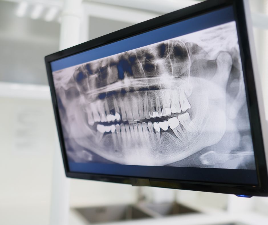 Avantajele chirurgiei ghidate digital în implantologie